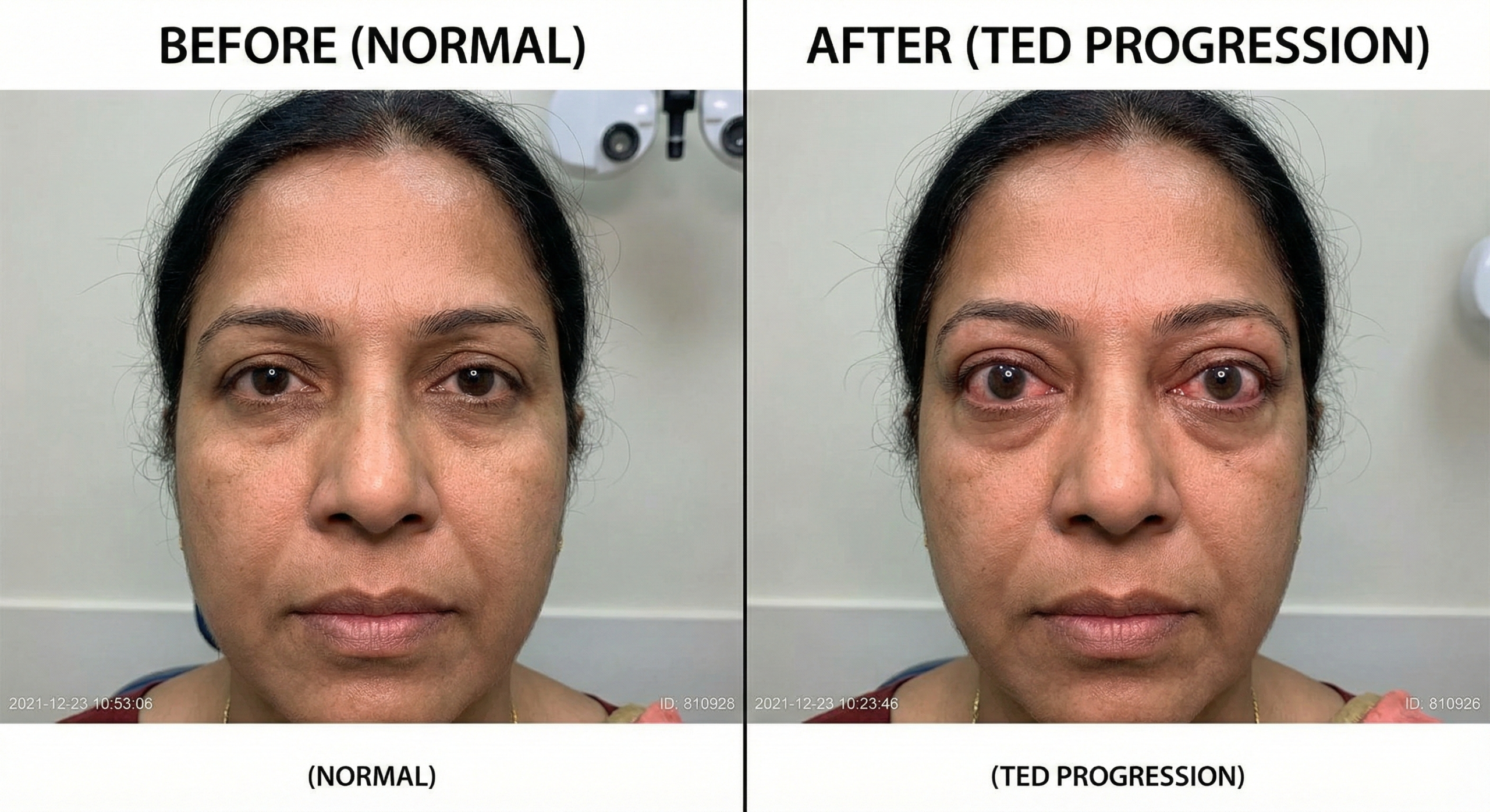 Thyroid related eye disease