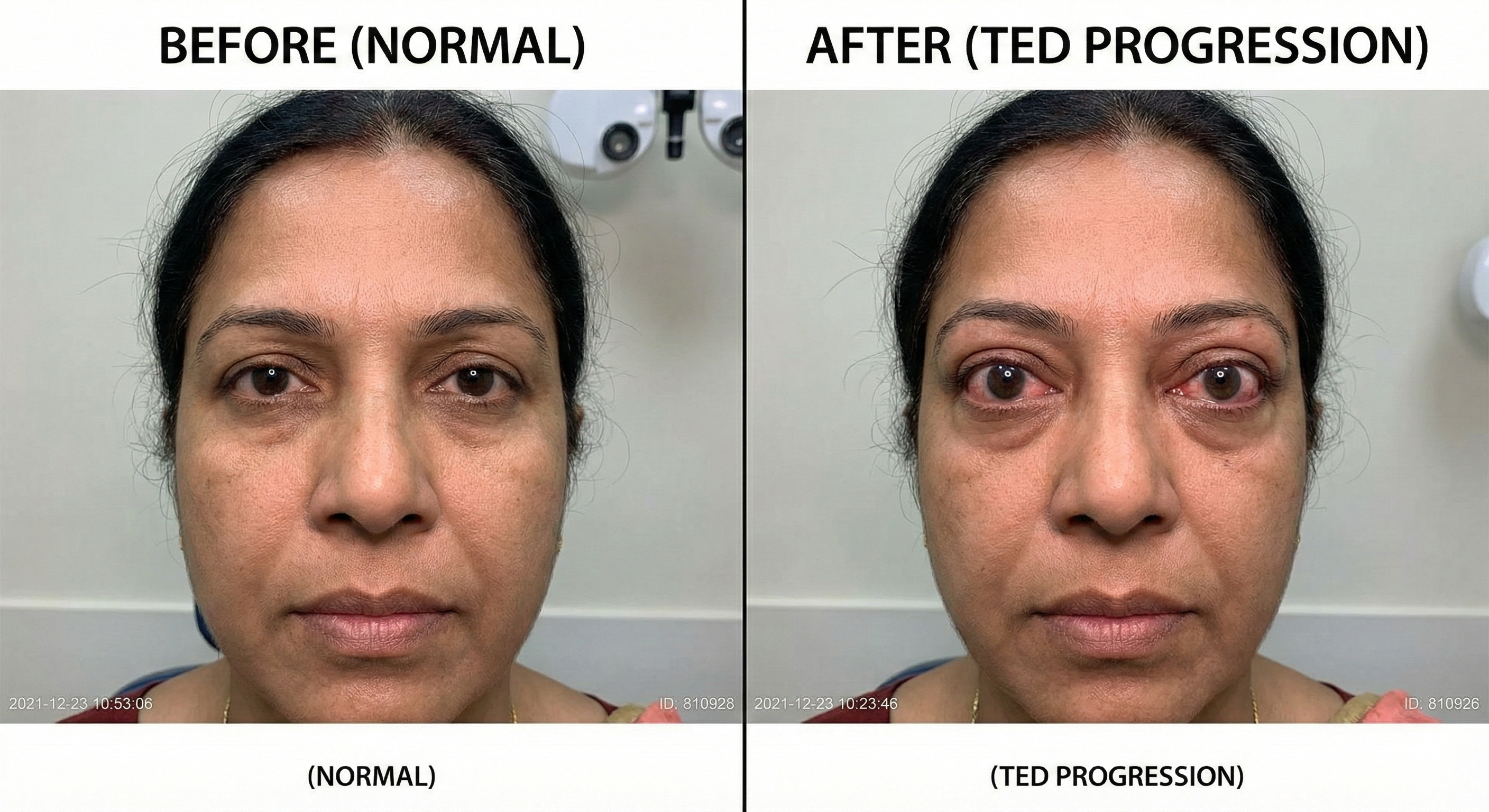 Thyroid-Related Eye Disease (Thyroid Eye Disease)