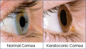 Keratoconus Illustration